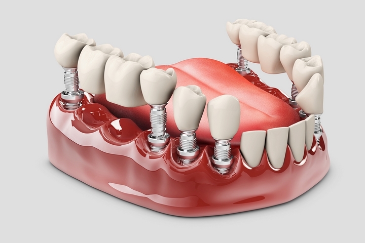 Chrysalis Dental Implants Centres
